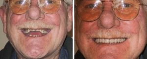 male-older-smile-before-after