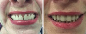 new-vs-old-teeth-female