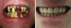 rotten-vs-good-teeth