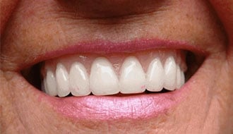 before-female-dentures