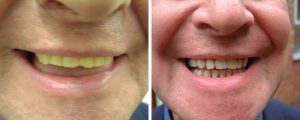 male-comparison-new-teeth-before-after