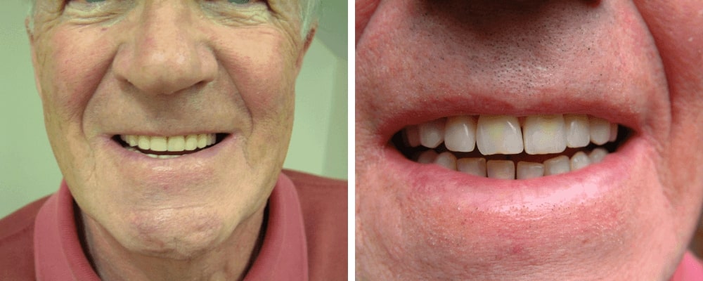 happy-male-before-vs-after-teeth