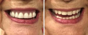 female-smile-before-after