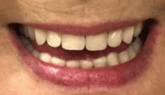older-female-better-dentures