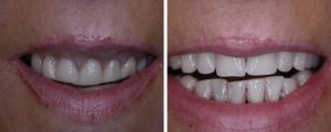 teeth-before-after-images
