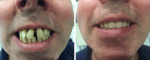 male-teeth-before-after
