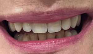 after-dentures-top-teeth-female