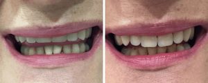 before-after-female-dentures