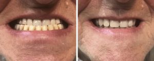 before-after-male-dentures