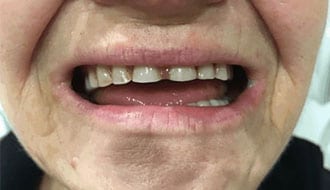 unhappy-before-dentures-female