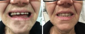 old-female-before-after-teeth-new