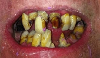 rotten-teeth-before-dentures