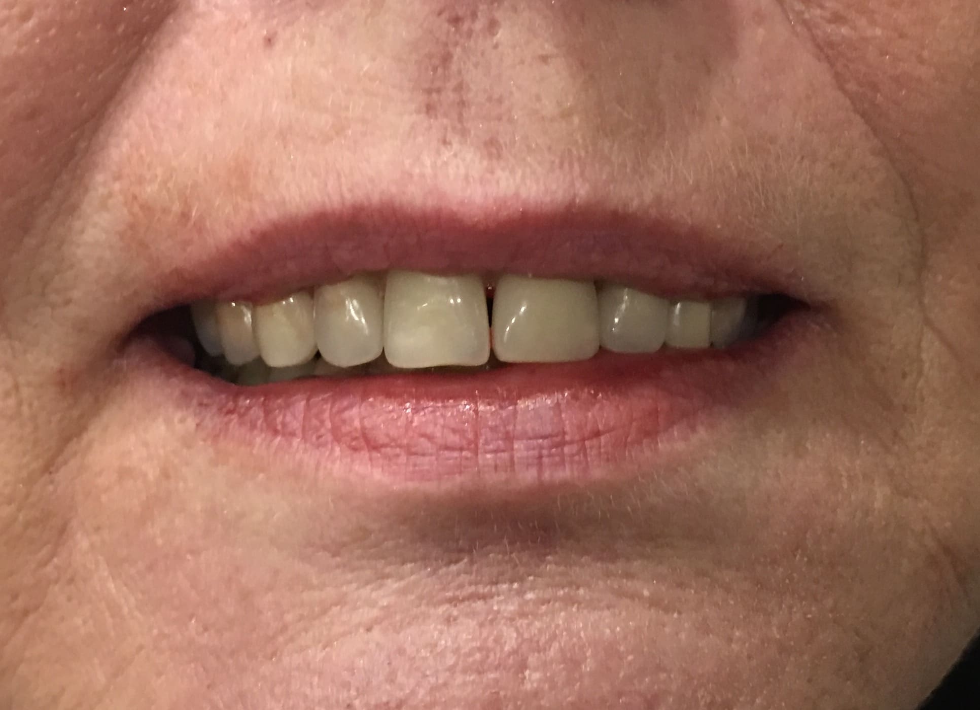 close-up-female-teeth
