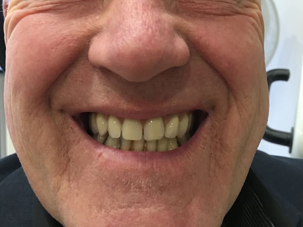 happy-after-dentures-male-image