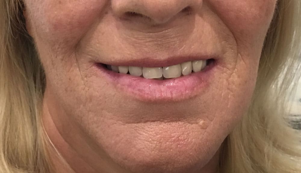 after-dentures-happy-elder-woman