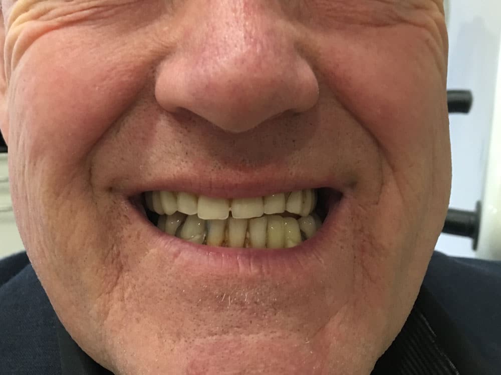 before-unhappy-teeth-male