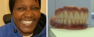 female-dentures-images