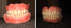 gum-teeth-comparison-image