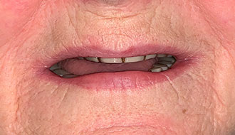 older-teeth-woman-before