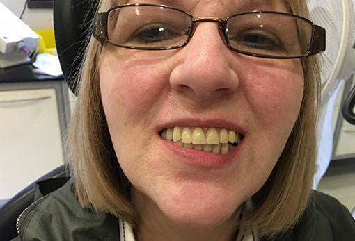 female-patient-before-dentures